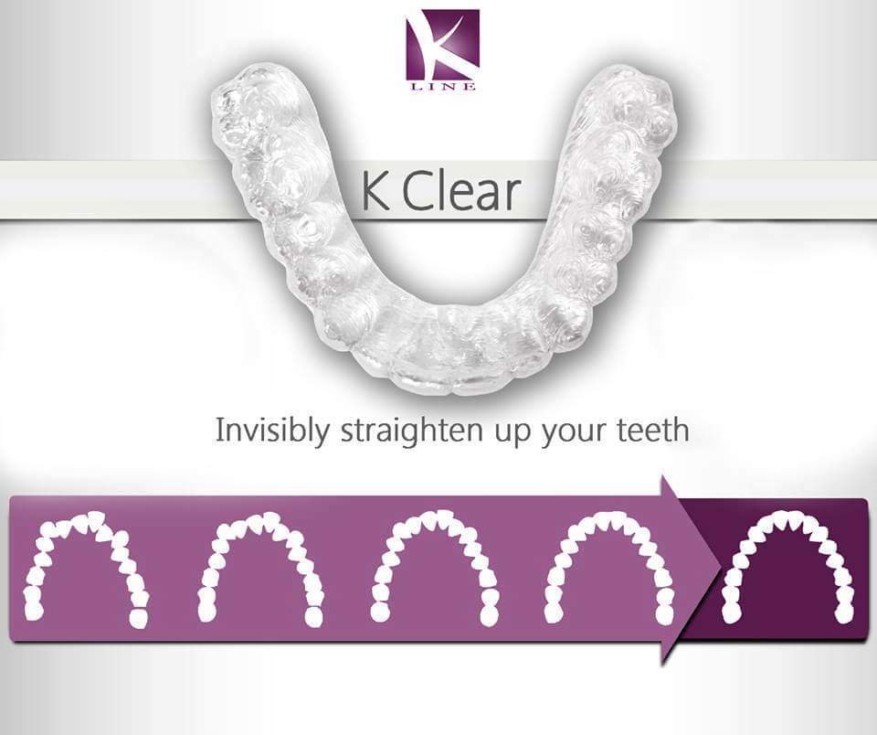 K Clear Tooth Correction Aligner